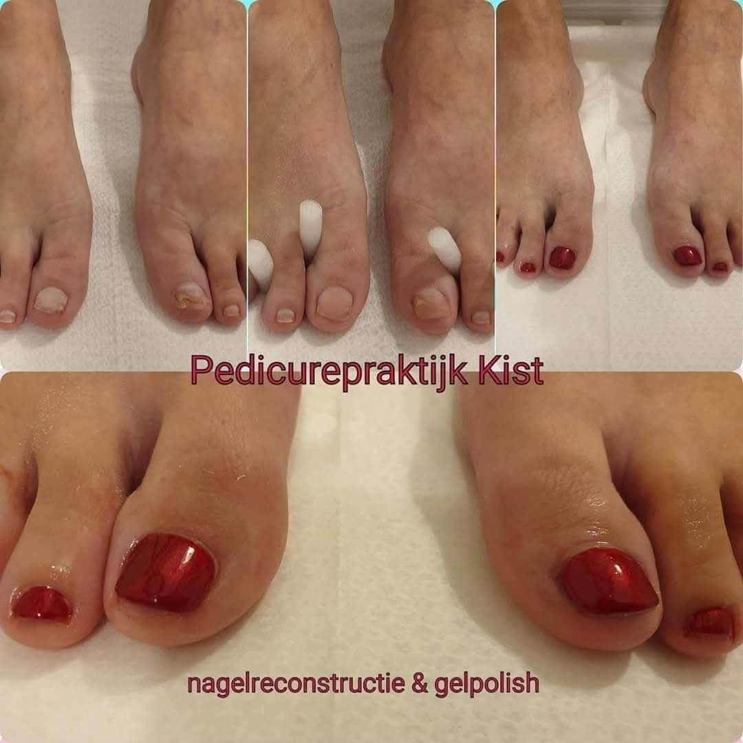 Voor en na nagelreconstructie en gelpolish